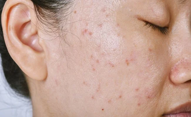 Cách Chăm Sóc Da Dầu Đúng Cách